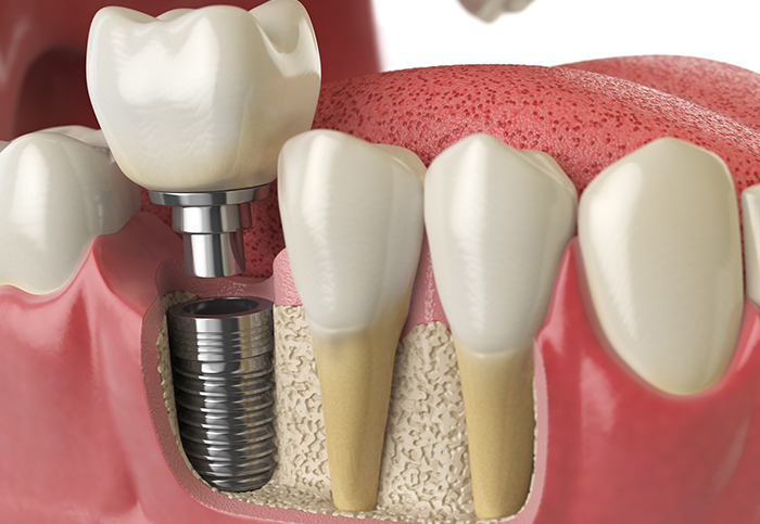 dental-implant