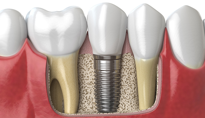 dental-implant2