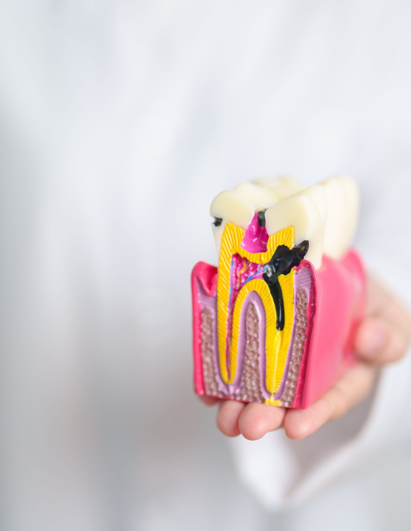 Tooth anatomy model illustrating decay