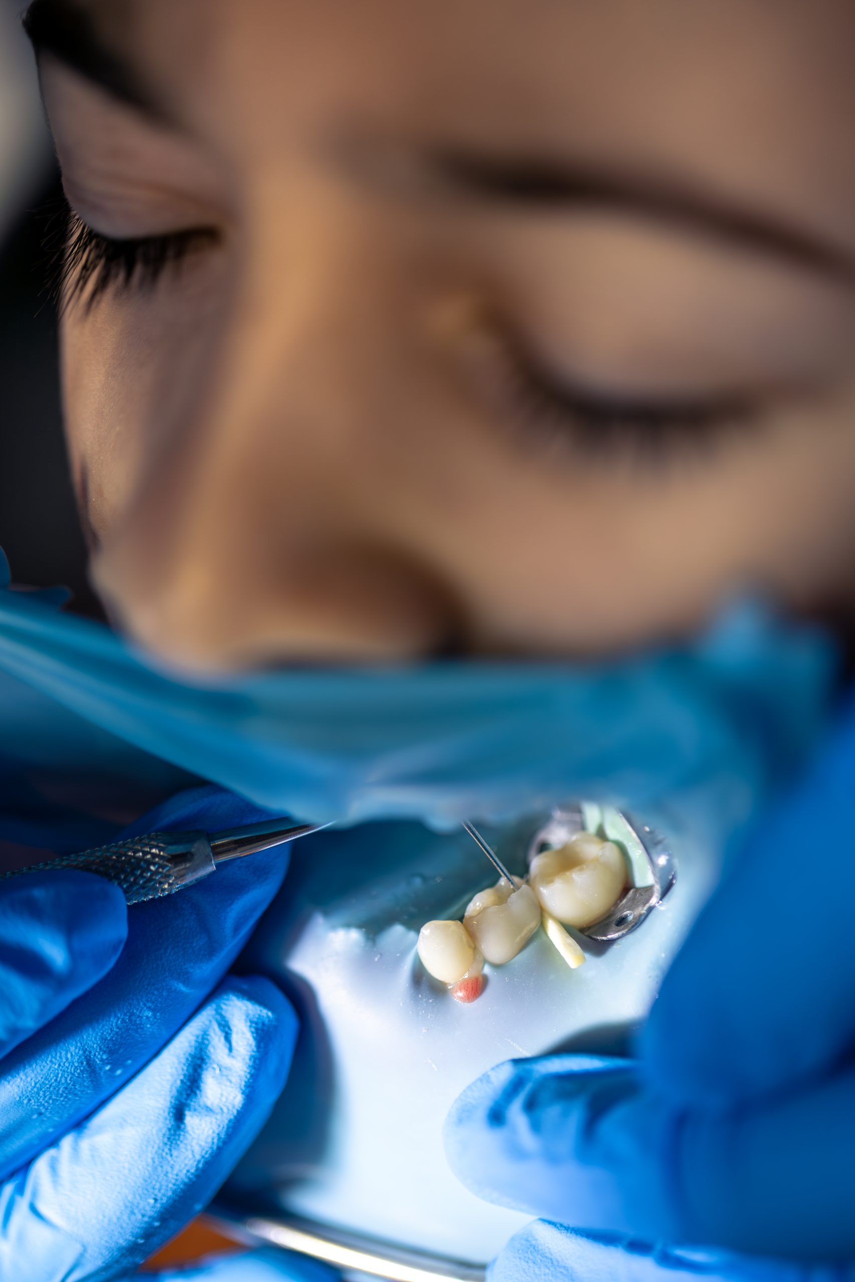 Dentist treating a child’s tooth using a dental instrument with a cheek retractor