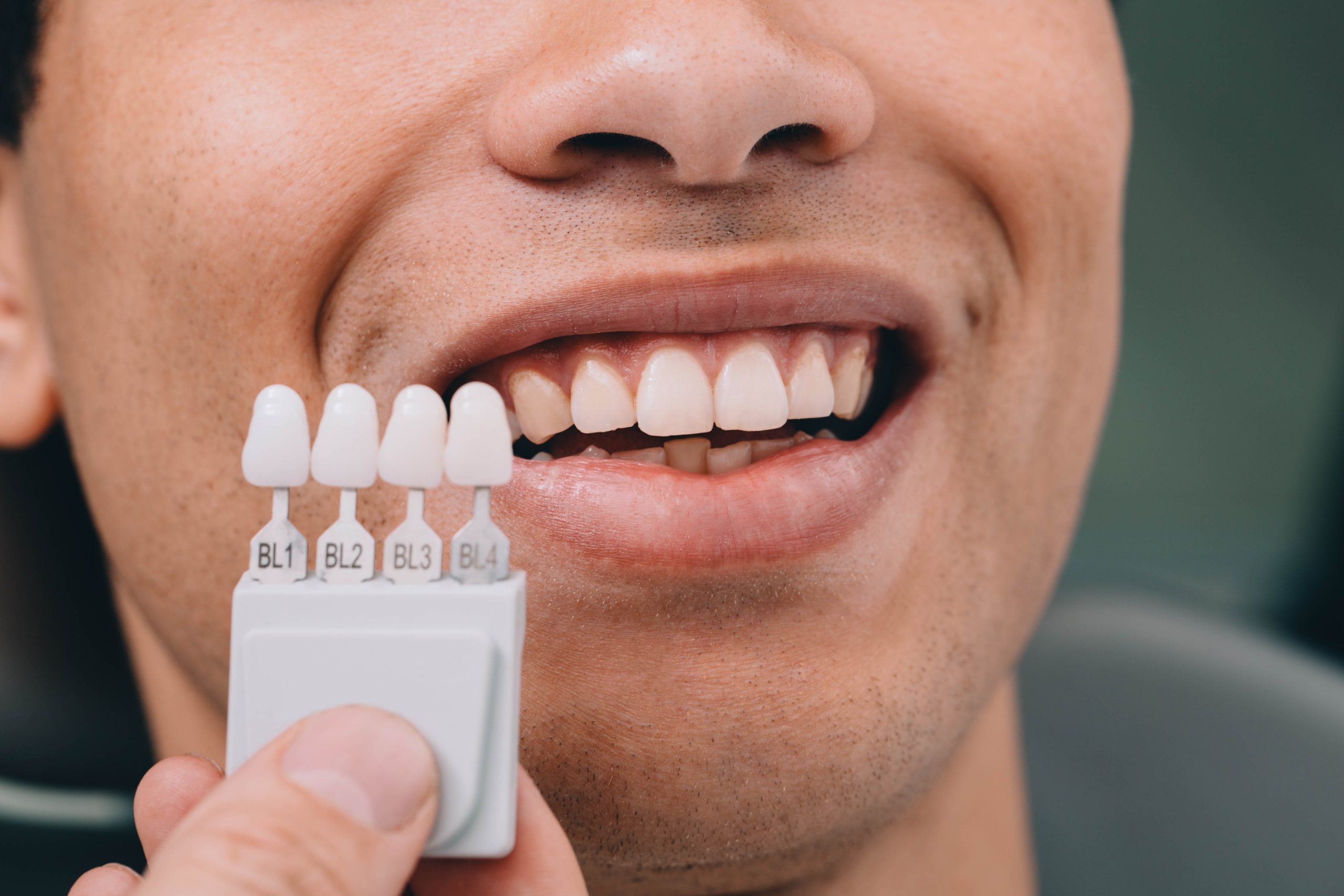 Dentist selecting tooth shade using a dental shade guide